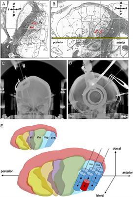 Stereotactic Lesioning of the Thalamic Vo Nucleus for the Treatment of Writer's Cramp (Focal Hand Dystonia)